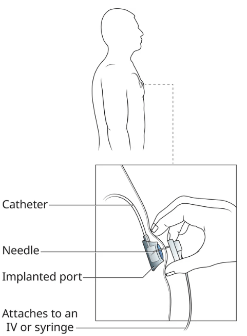 Port-a-cath under the skin and an IV attaching to the implanted port.