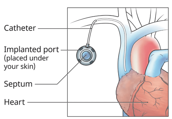 Image of the implanted port and the catheter entering a large vein above the heart.